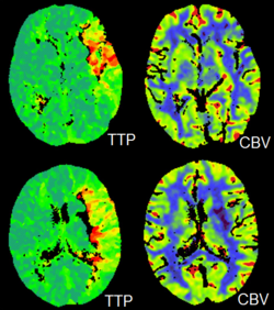 ภาพ CT Perfusion ของสมอง