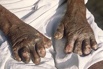 มือผิดรูปจากโรคเรื้อน