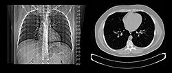 เครื่อง Spiral CT Scan