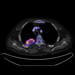 เครื่อง PET-CT Scan